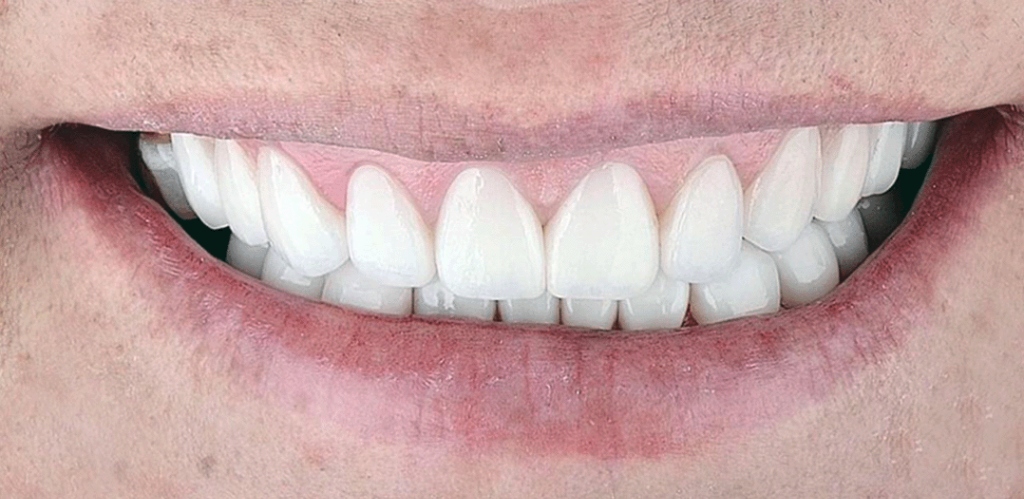 Sonrisa Después